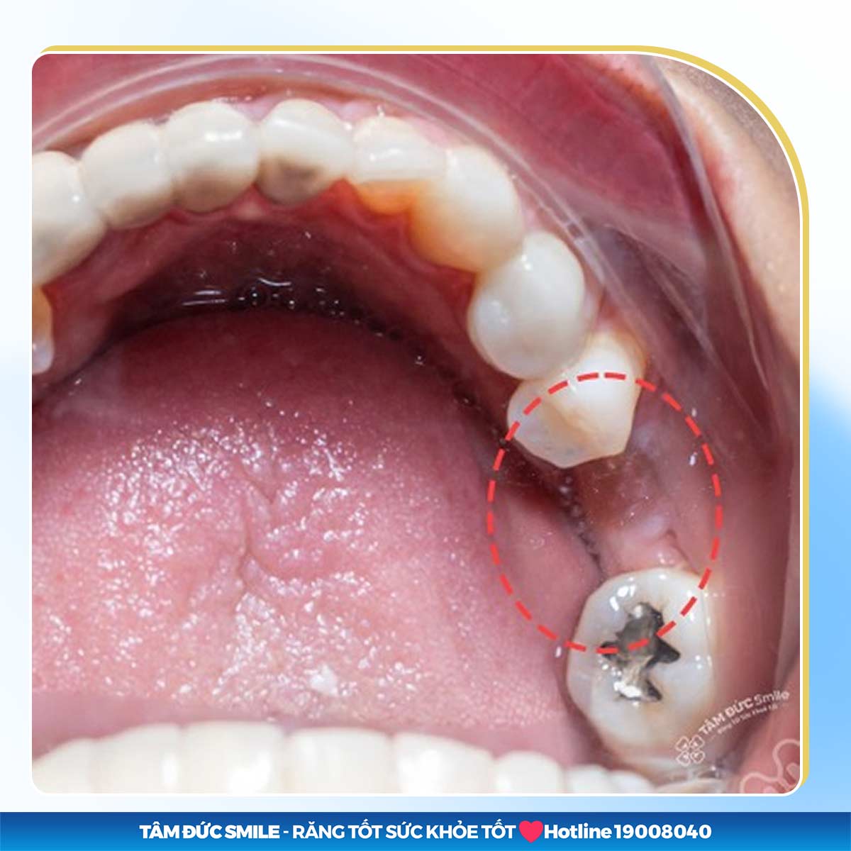 DẤU HIỆU TIÊU XƯƠNG RĂNG QUA TỪNG GIAI ĐOẠN