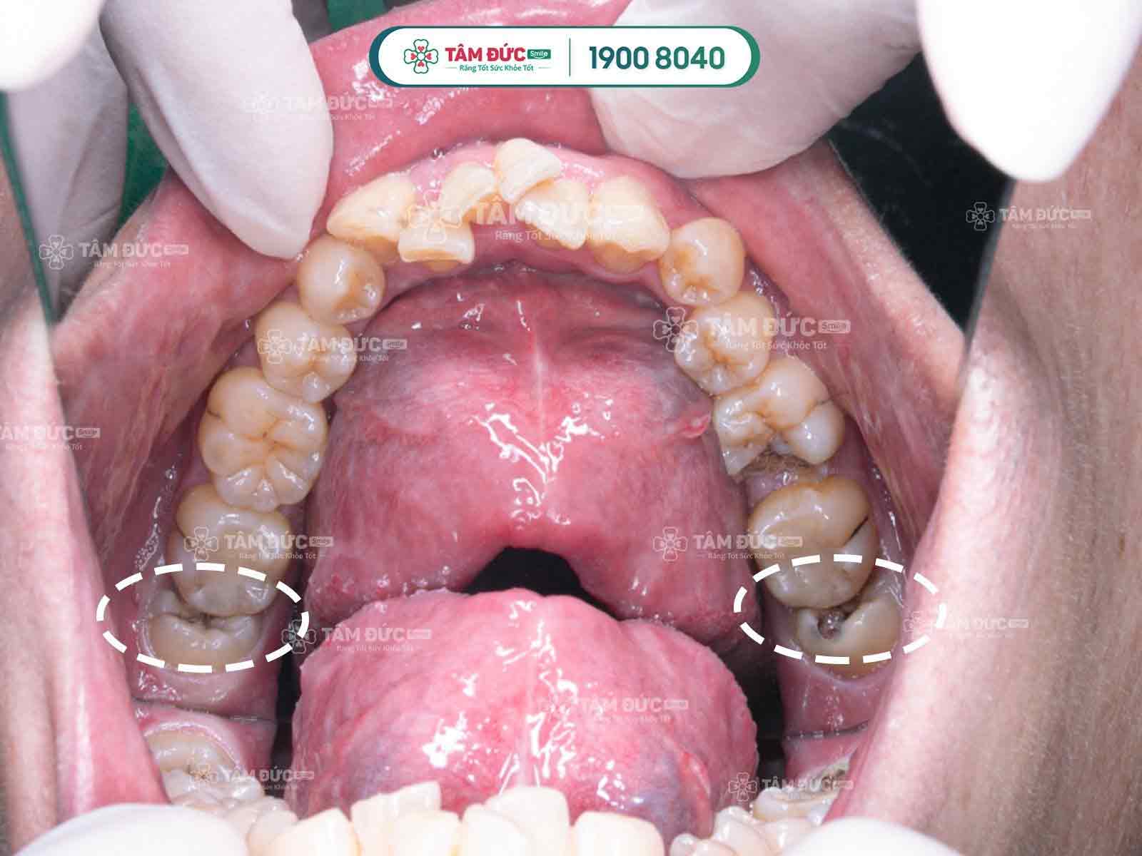 nguyên nhân mọc răng khôn bị đau