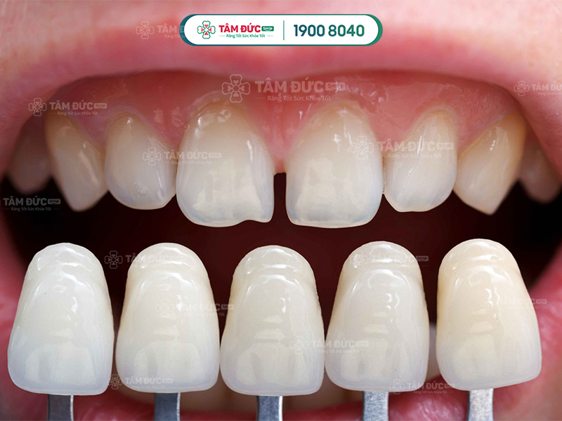 Mặt dán sứ Veneer giá bao nhiêu tiền?