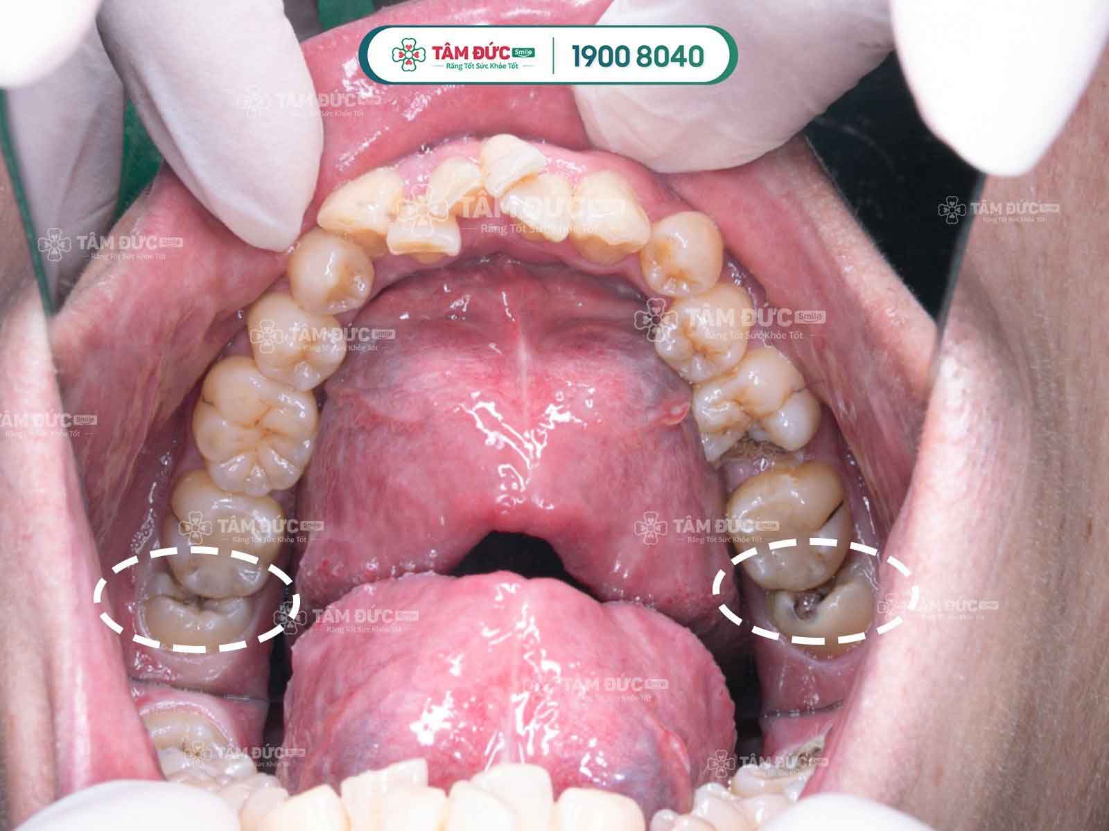 Mọc răng khôn có ý nghĩa gì