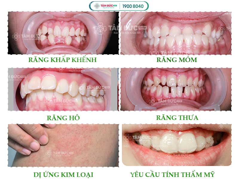 các trường hợp nên niềng răng không mắc cài