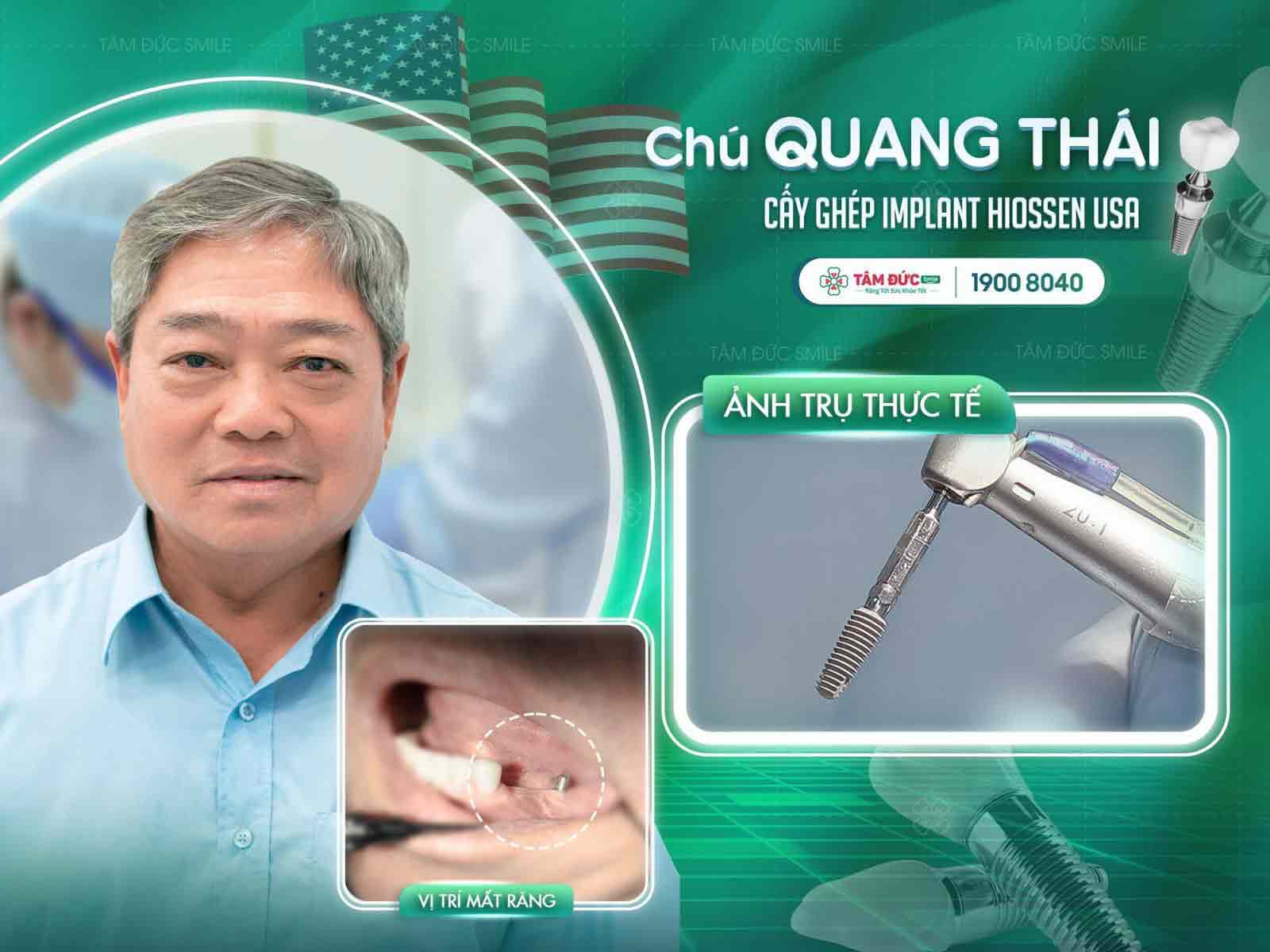 răng bị sâu ăn mòn hết cần phải nhổ bỏ