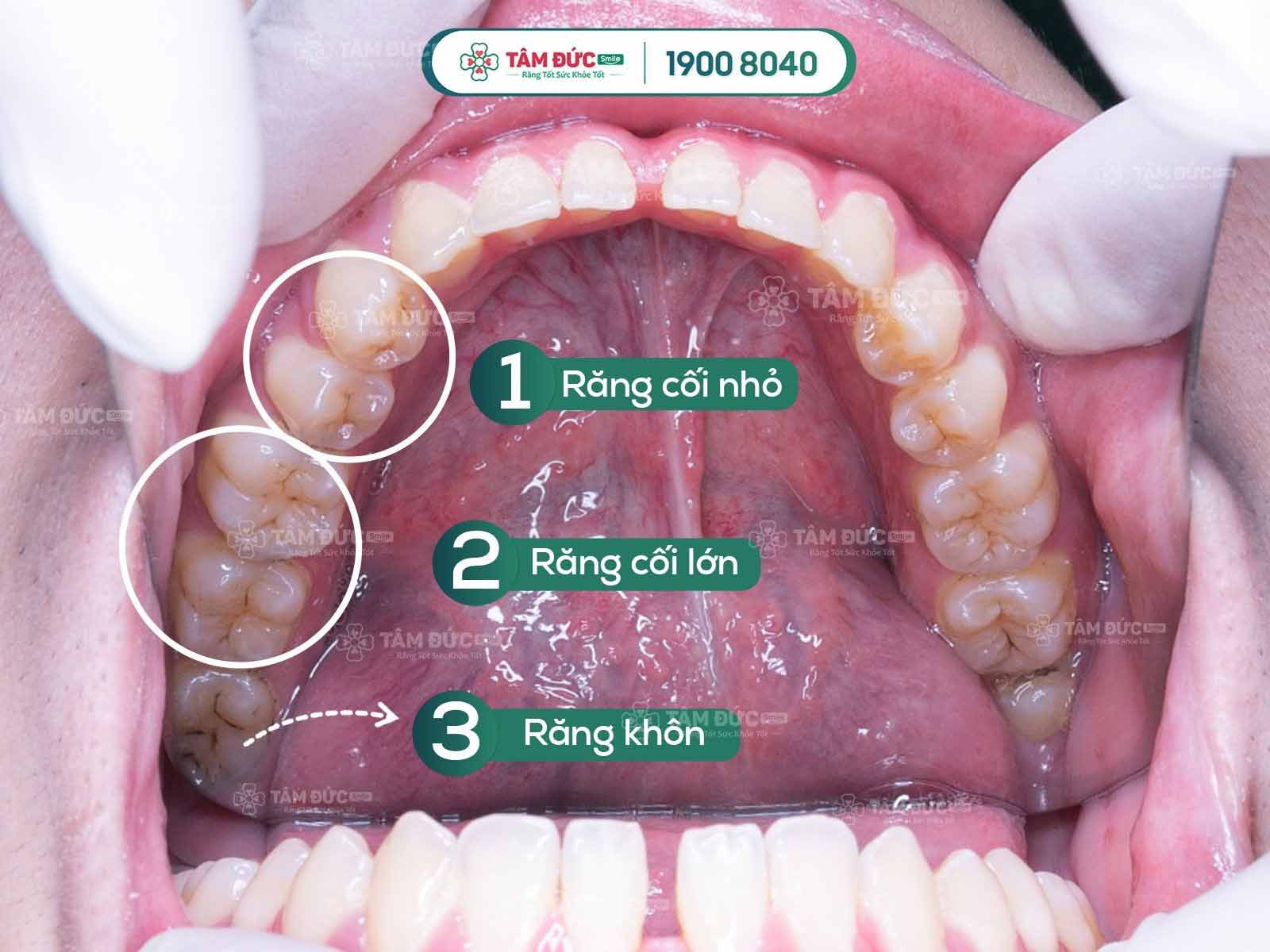 răng cối là gì