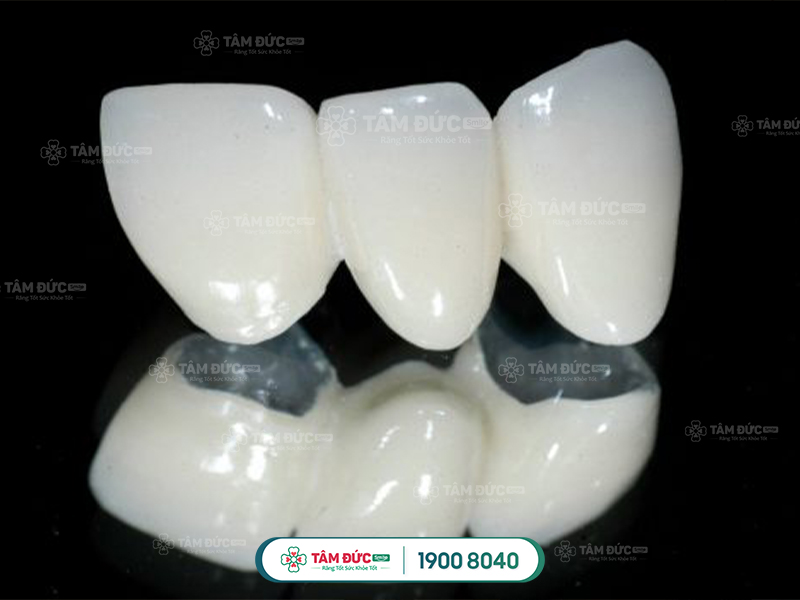 Răng Sứ Titan Là Gì?