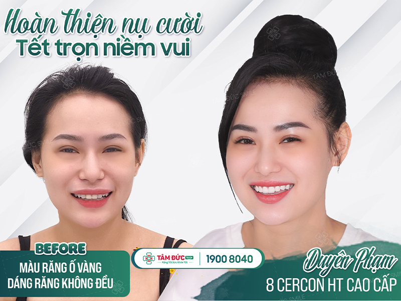 RĂNG TOÀN SỨ GIẢI PHÁP PHỤC HÌNH RĂNG AN TOÀN VÀ THẨM MỸ 