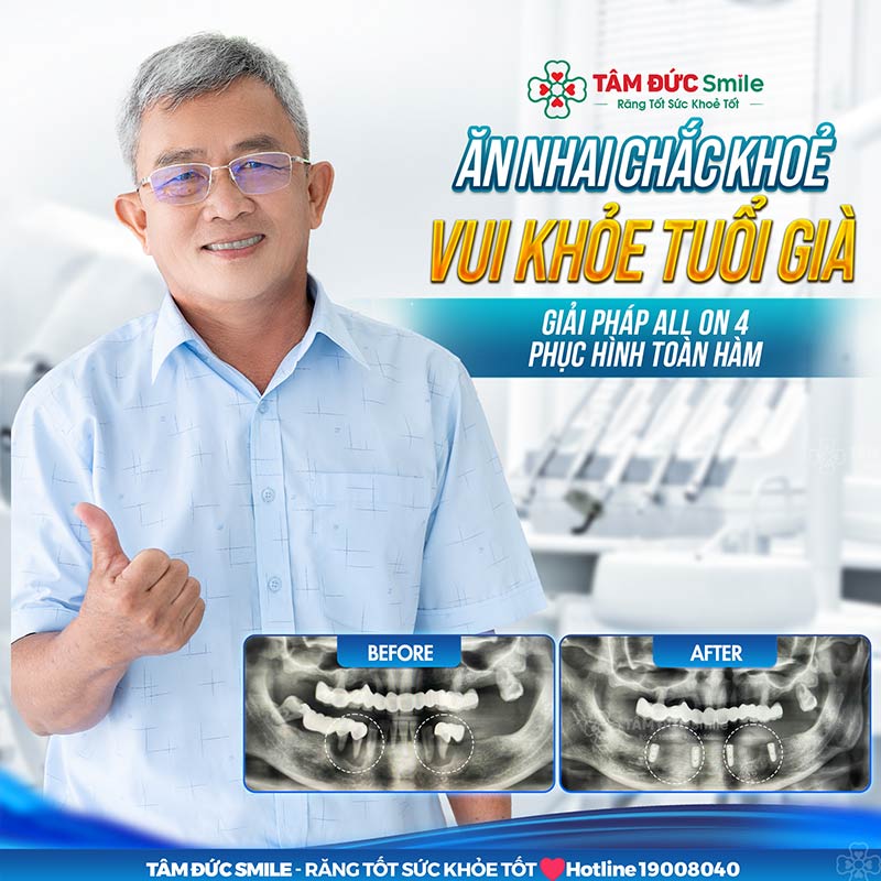 ưu điểm của trồng răng implant all on 4
